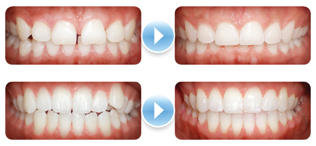 clearcorrect before and after