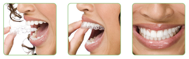 clearcorrect sequence